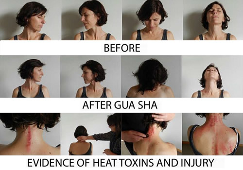 Gua Sha before and after examples